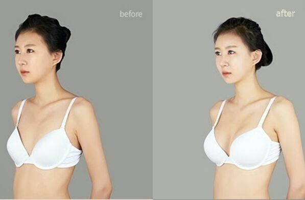 před a po plastické augmentaci prsou