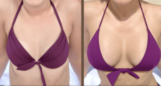 Před a po operaci augmentace prsou