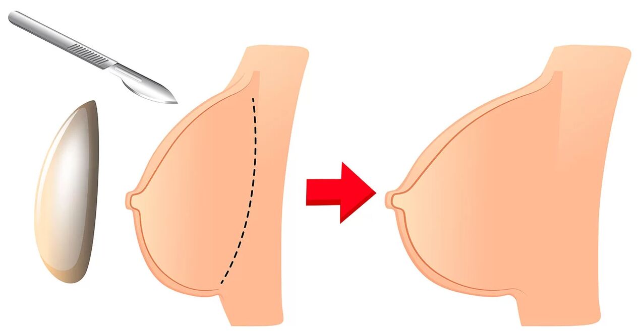 Zvětšení prsou pomocí implantátu