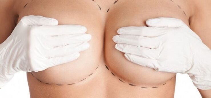 zvětšení prsou chirurgickým zákrokem
